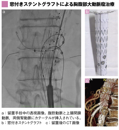 窓付きステントグラフトによる胸腹部大動脈瘤治療 窓付きステントグラフトによる胸腹部大動脈瘤治療
