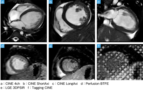 症例5:心筋症(1歳,男児)のシネMRI 症例5:心筋症(1歳,男児)のシネMRI