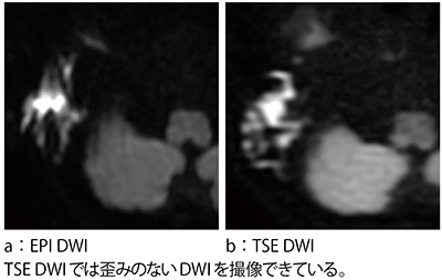 症例3:真珠腫のTSE DWI 症例3:真珠腫のTSE DWI