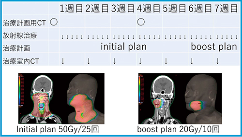 図1 Two-step法IMRT(右扁桃がんの一例) 図1 Two-step法IMRT(右扁桃がんの一例)